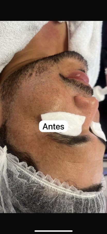 Antes y despues paciente 1 Vanessa Beauty Studio