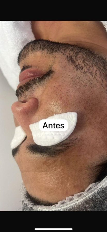 Antes y despues paciente 2 Vanessa Beauty Studio