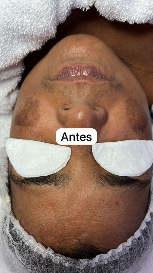Antes y despues paciente 9 Vanessa Beauty Studio