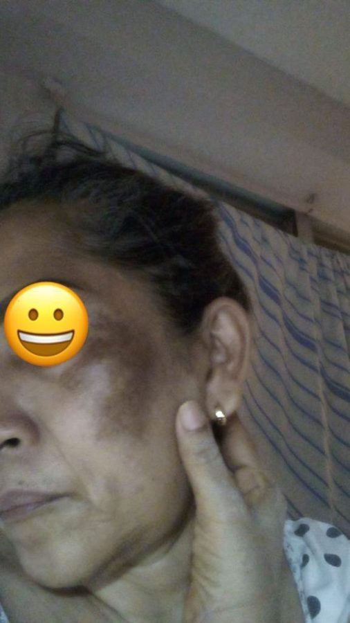 Antes y despues paciente 11 Vanessa Beauty Studio