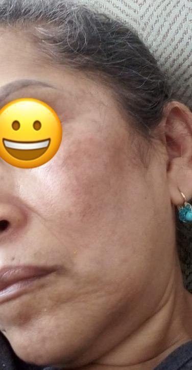 Antes y despues paciente 14 Vanessa Beauty Studio