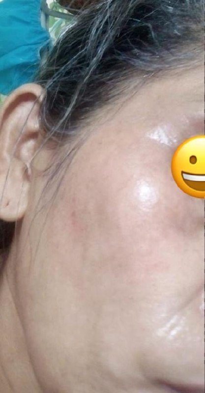Antes y despues paciente 15 Vanessa Beauty Studio
